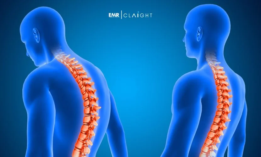 Top Companies in the Spinal Laminoplasty Market