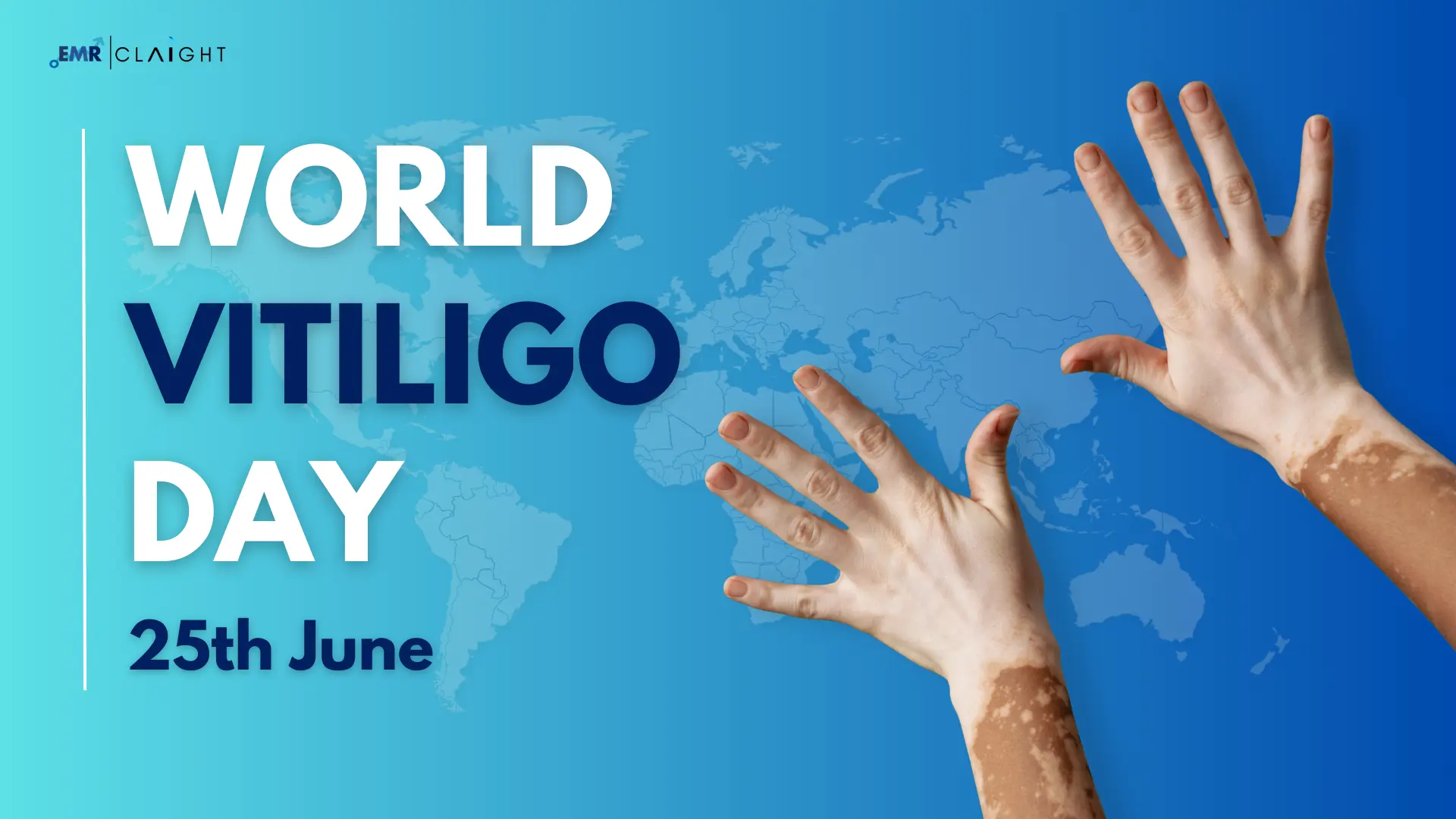 Vitiligo - A Rare Skin Disorder That Affects Nearly 1% of the Global Population